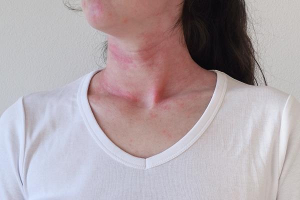 Woman Breaking Out In Hives From An Allergic Reaction